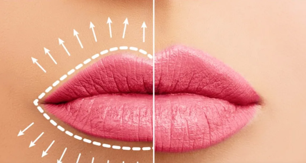 Botox Lip Flip vs Filler