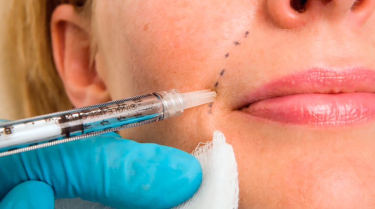 Dermal Fillers For Smokers Lines
