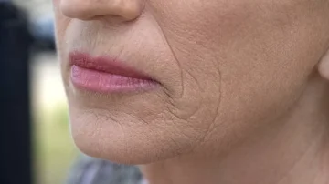 Best Treatment for Wrinkles Above Lips