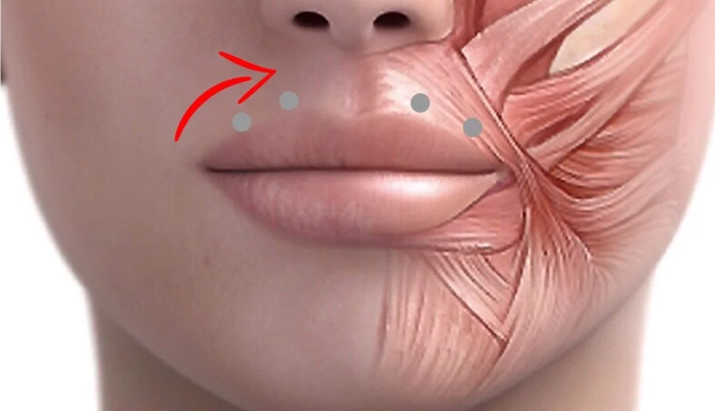 Botox Around Mouth