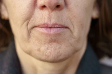 Get Rid of Smokers Lips