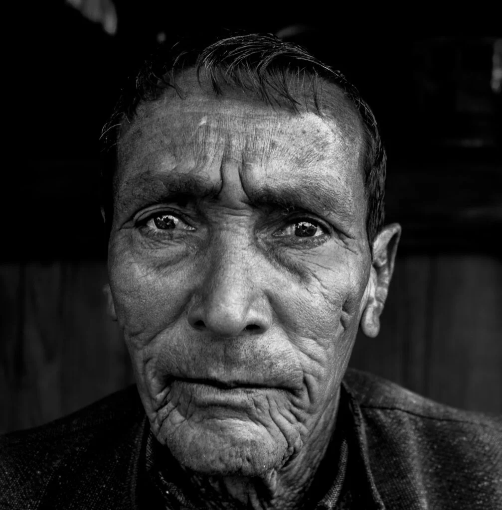 Smokers Wrinkles Around Mouth
