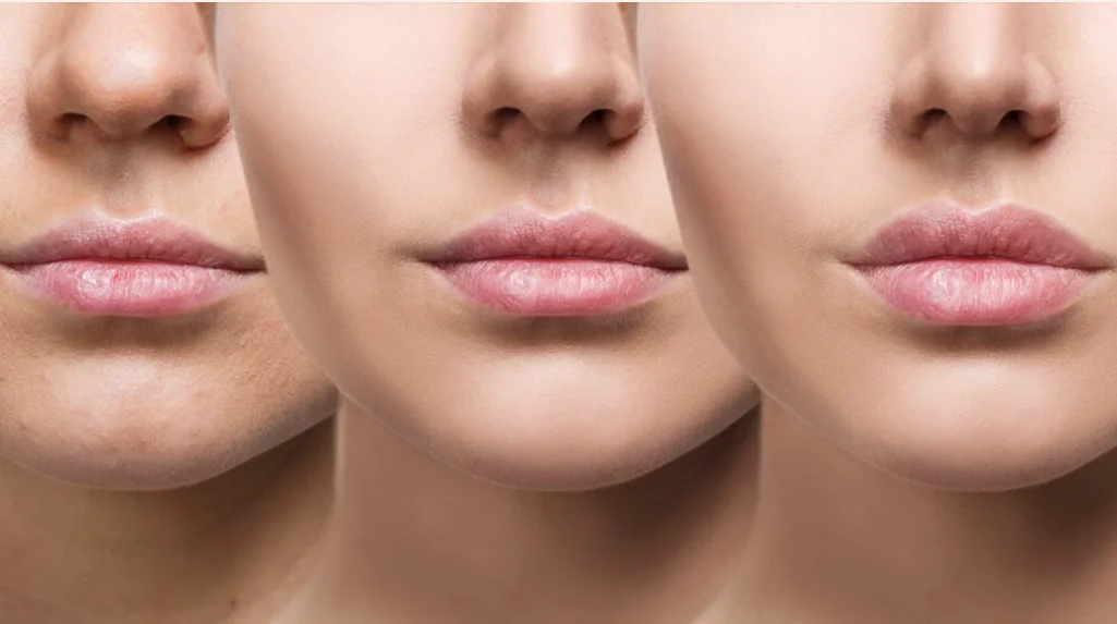 Can You Smoke After Lip Fillers Can You Smoke After Lip Fillers