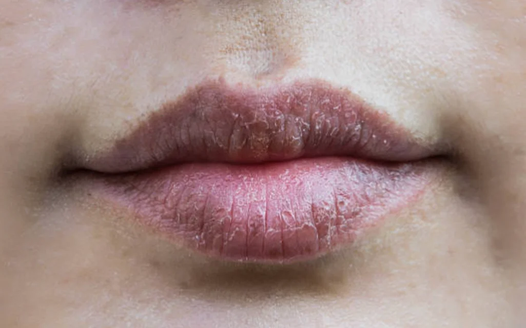 Dehydration Lip Wrinkles