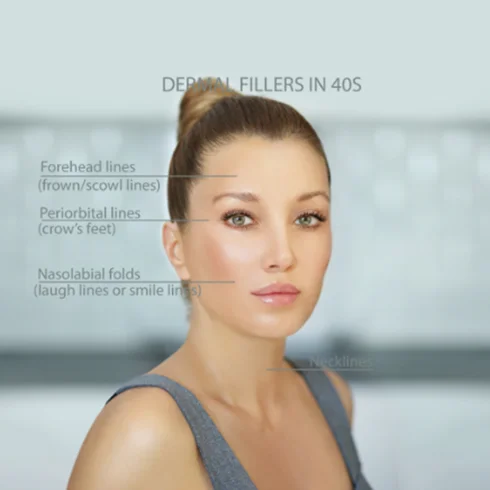 Smokers Lines Botox