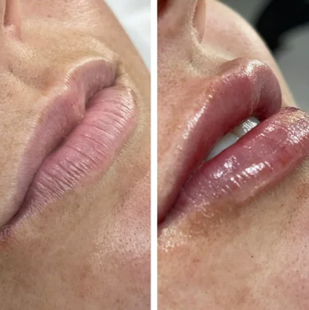 Smoking and Lip Fillers
